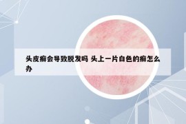 头皮癣会导致脱发吗 头上一片白色的癣怎么办