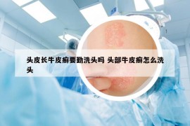 头皮长牛皮癣要勤洗头吗 头部牛皮癣怎么洗头