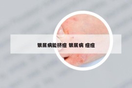 银屑病能挤痘 银屑病 痘痘