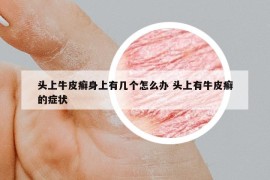 头上牛皮癣身上有几个怎么办 头上有牛皮癣的症状