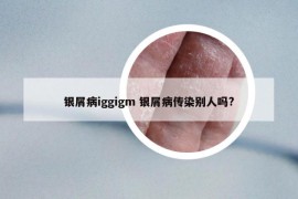 银屑病iggigm 银屑病传染别人吗?