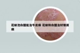花椒泡白醋能治牛皮癣 花椒和白醋治好银屑病