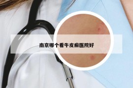 南京哪个看牛皮癣医院好