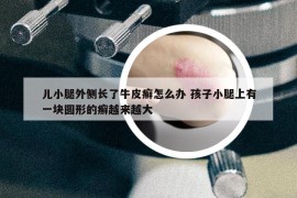 儿小腿外侧长了牛皮癣怎么办 孩子小腿上有一块圆形的癣越来越大