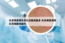 头皮银屑病头皮红点越来越多 头皮银屑病发红范围越来越大