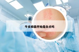 牛皮癣最开始是白点吗