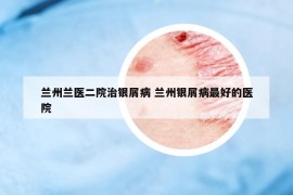 兰州兰医二院治银屑病 兰州银屑病最好的医院