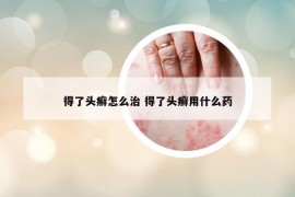 得了头癣怎么治 得了头癣用什么药