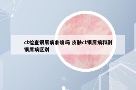 ct检查银屑病准确吗 皮肤ct银屑病和副银屑病区别