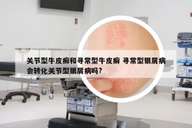 关节型牛皮癣和寻常型牛皮癣 寻常型银屑病会转化关节型银屑病吗?