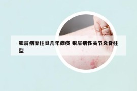银屑病脊柱炎几年瘫痪 银屑病性关节炎脊柱型