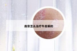 南京怎么治疗牛皮癣的