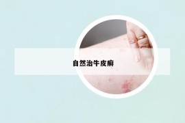 自然治牛皮癣