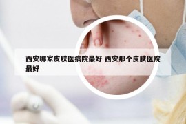 西安哪家皮肤医病院最好 西安那个皮肤医院最好