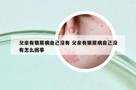 父亲有银屑病自己没有 父亲有银屑病自己没有怎么回事
