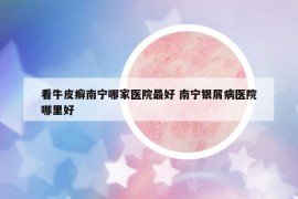 看牛皮癣南宁哪家医院最好 南宁银屑病医院哪里好