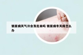 银屑病天气冷会发出来吗 银屑病冬天痒怎么办