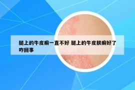 腿上的牛皮癣一直不好 腿上的牛皮肤癣好了咋回事