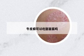 牛皮癣可以吃甜面酱吗