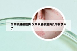 父亲银屑病遗传 父亲银屑病遗传几率有多大了