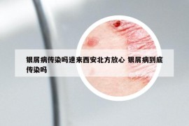 银屑病传染吗速来西安北方放心 银屑病到底传染吗