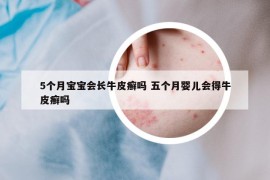 5个月宝宝会长牛皮癣吗 五个月婴儿会得牛皮癣吗