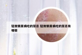 轻微银屑病吃的禁忌 轻微银屑病吃的禁忌有哪些