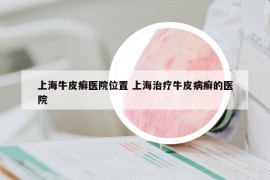 上海牛皮癣医院位置 上海治疗牛皮病癣的医院