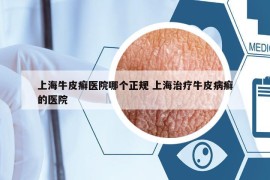 上海牛皮癣医院哪个正规 上海治疗牛皮病癣的医院
