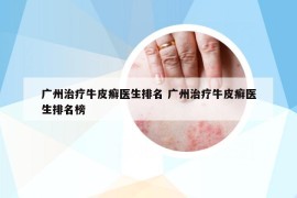 广州治疗牛皮癣医生排名 广州治疗牛皮癣医生排名榜
