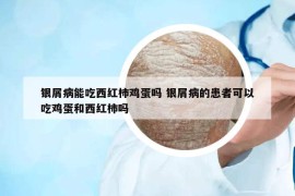 银屑病能吃西红柿鸡蛋吗 银屑病的患者可以吃鸡蛋和西红柿吗