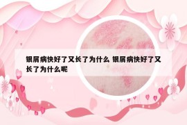 银屑病快好了又长了为什么 银屑病快好了又长了为什么呢