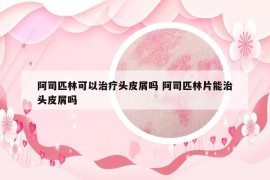 阿司匹林可以治疗头皮屑吗 阿司匹林片能治头皮屑吗