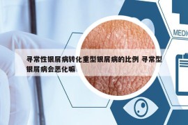 寻常性银屑病转化重型银屑病的比例 寻常型银屑病会恶化嘛