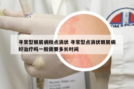 寻常型银屑病和点滴状 寻常型点滴状银屑病好治疗吗一般需要多长时间