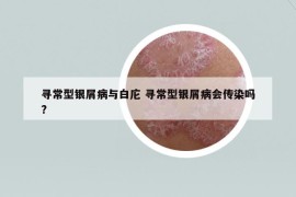 寻常型银屑病与白庀 寻常型银屑病会传染吗?