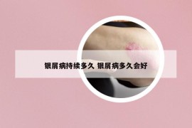 银屑病持续多久 银屑病多久会好