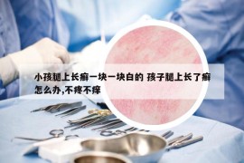 小孩腿上长癣一块一块白的 孩子腿上长了癣怎么办,不疼不痒
