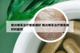 银川哪家治疗银屑病好 银川哪家治疗银屑病好的医院
