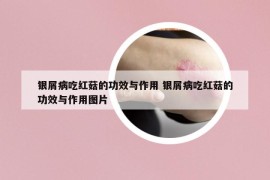银屑病吃红菇的功效与作用 银屑病吃红菇的功效与作用图片
