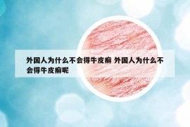 外国人为什么不会得牛皮癣 外国人为什么不会得牛皮癣呢