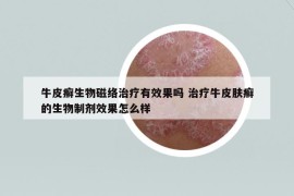 牛皮癣生物磁络治疗有效果吗 治疗牛皮肤癣的生物制剂效果怎么样