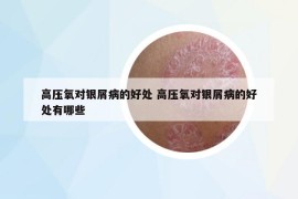 高压氧对银屑病的好处 高压氧对银屑病的好处有哪些