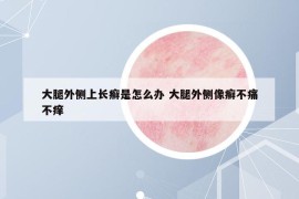 大腿外侧上长癣是怎么办 大腿外侧像癣不痛不痒