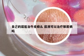 自己的尿能治牛皮癣么 尿液可以治疗银屑病吗