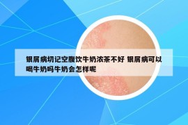 银屑病切记空腹饮牛奶浓茶不好 银屑病可以喝牛奶吗牛奶会怎样呢