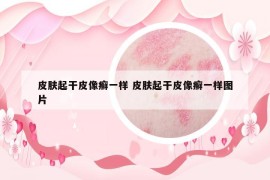 皮肤起干皮像癣一样 皮肤起干皮像癣一样图片