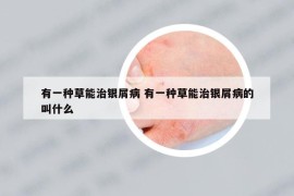 有一种草能治银屑病 有一种草能治银屑病的叫什么