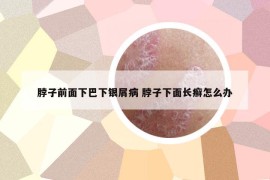 脖子前面下巴下银屑病 脖子下面长癣怎么办