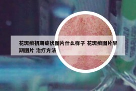 花斑癣初期症状图片什么样子 花斑癣图片早期图片 治疗方法